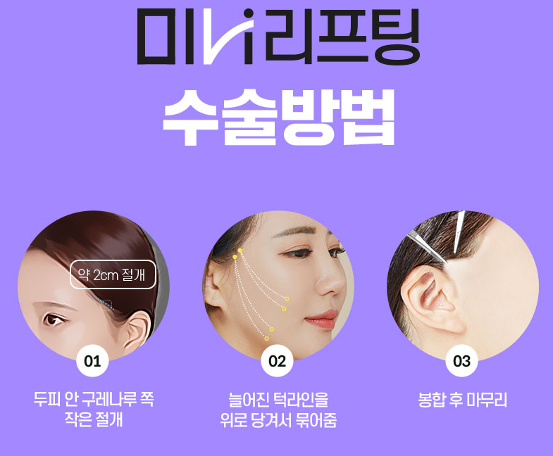 리팅 미니리프팅 수술방법